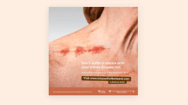 An image of a poster showing a female chest with a noticeable, graphical representation of itchy skin